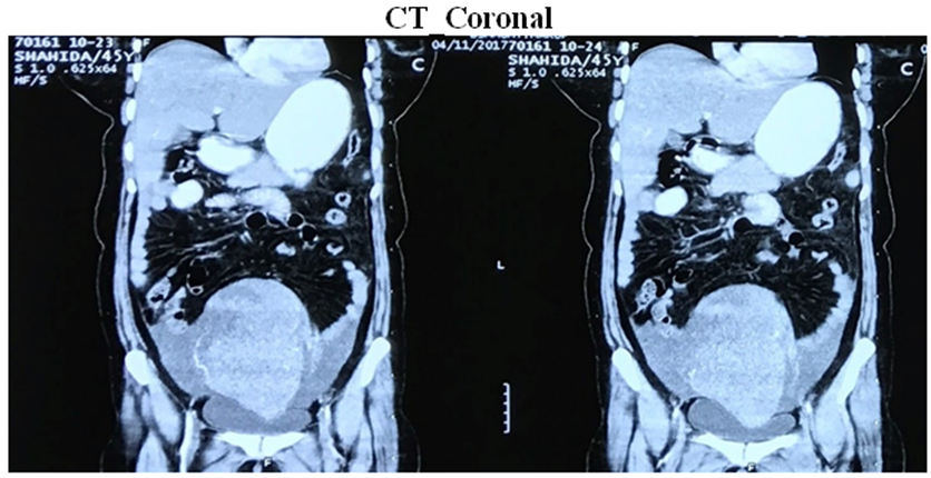 Primary Ovarian Non-Hodgkin’s Lymphoma with Late Diagnosis Due to Unusual Presentation - A Case Report