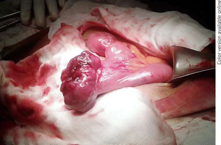 Primary Jejunal Gastrointestinal Stromal Tumor: Diagnosis Delay of 3 Years but Successful Management in Early Stage (II) by Surgery and Adjuvant Therapy